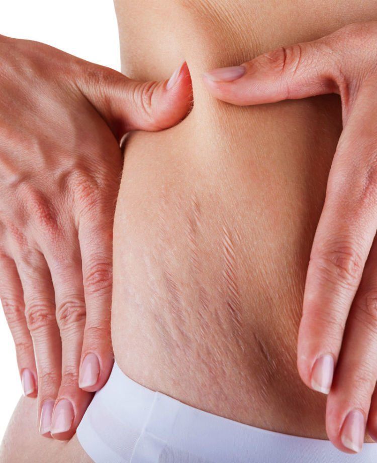 Stretchmark gini bisa muncul di wajah juga?