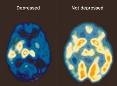 Jangan Pernah Meremehkan Kesehatan Mental Seseorang