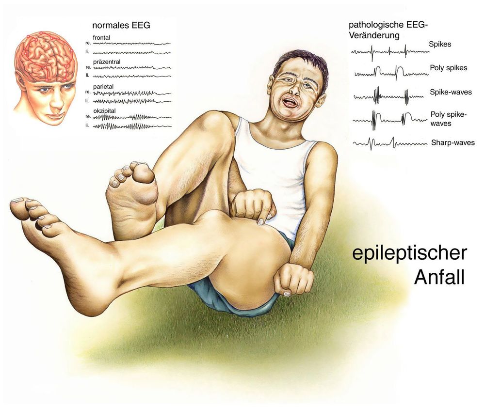 Mengenal Lebih Jauh tentang Epilepsi. Yuk, Kenali lebih Dalam