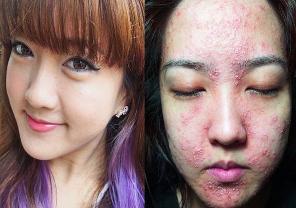 7 Kasus Kulit Rusak Akibat Pemakaian Make-Up. Jangan Sampai Kamu Mengalaminya!