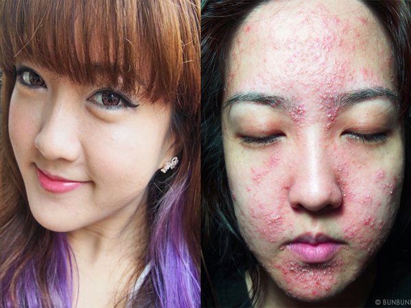 7 Kasus Kulit Rusak Akibat Pemakaian Make-Up. Jangan Sampai Kamu Mengalaminya!