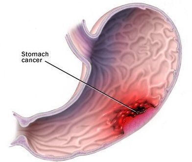 kanker lambung