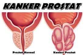 penderita kanker prostat pada pria