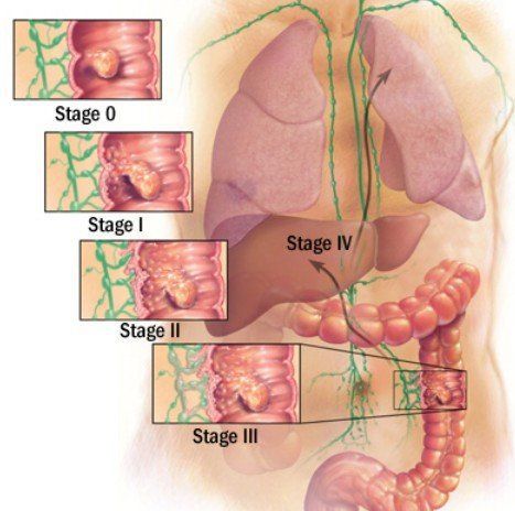 gambaran kanker usus besar