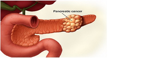 kanker pankreas sebenarnya