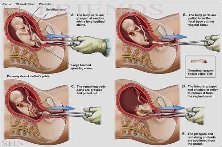 Setelah Melihat 5 Cara Aborsi yang Sadis Ini, Masih Kepikiran untuk ‘Membuat’ Bayi Terlalu Dini?