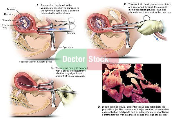 Ilustrasi aborsi dg metode sunction