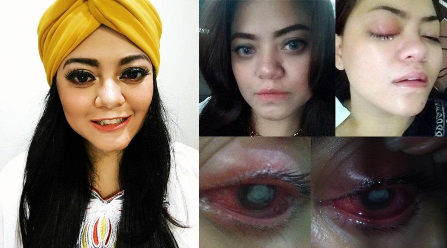 Mata Terserang Bakteri Ganas Akibat Ceroboh Pakai Softlens. Please, Kamu yang Hati-hati Ya!