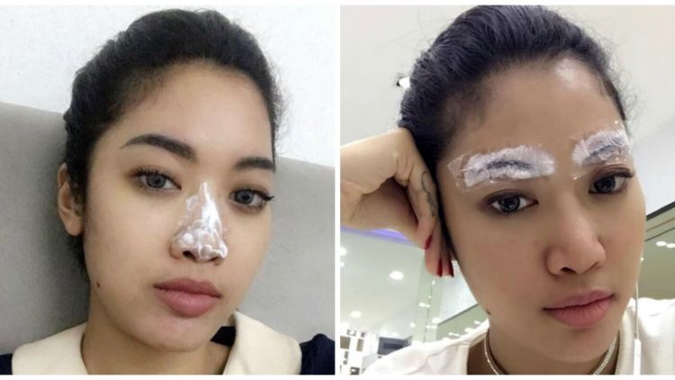 Dari Filler Hidung Sampai Infus Glowing. Yuk, Simak Cerita Pengalaman Widi Vierratale!