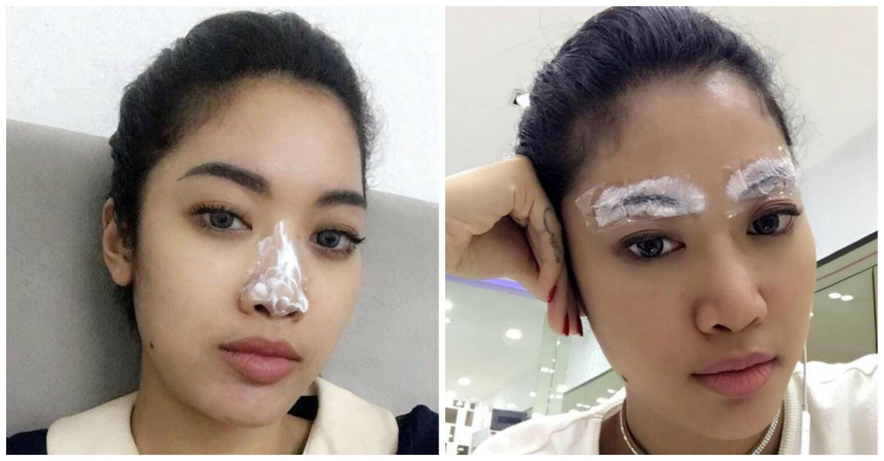 Dari Filler Hidung Sampai Infus Glowing. Yuk, Simak Cerita Pengalaman Widi Vierratale!