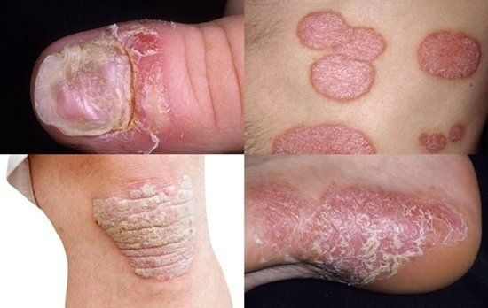 Psoriasis