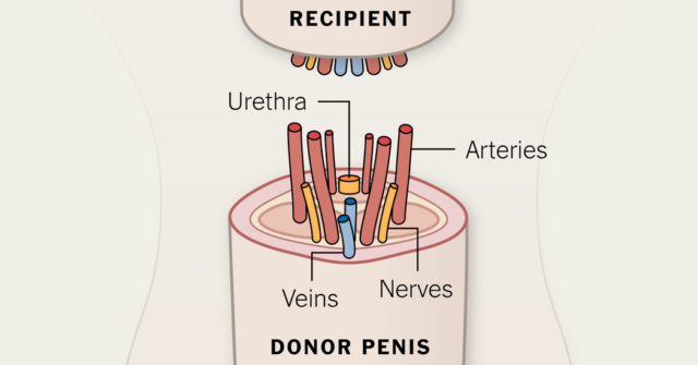 5 Fakta Tentang Transplantasi Mr. P. Ini Bukan Buat Kamu yang Nggak Puas Dengan Milikmu Sendiri!