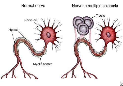 Multiple Sclerosis