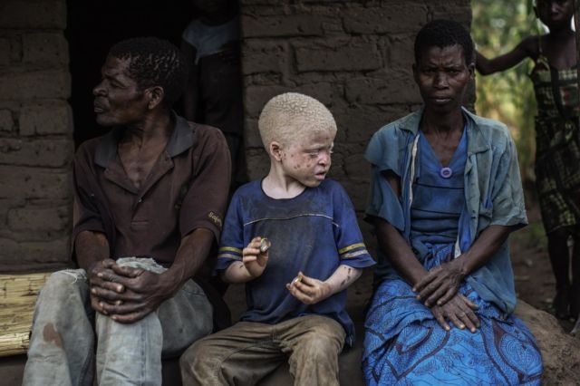 Kisah Sedih Orang Albino di Afrika, Diburu dan Dibunuh Karena Keunikannya. Ini 8 Faktanya