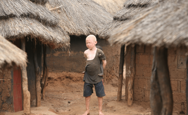 Kisah Sedih Orang Albino di Afrika, Diburu dan Dibunuh 