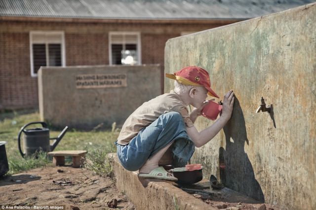 Kisah Sedih Orang Albino di Afrika, Diburu dan Dibunuh Karena Keunikannya. Ini 8 Faktanya