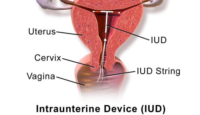 Mengenal Lebih Jauh Tentang IUD. Kok Bisa Sampai Ada Bayi Terlahir dengan Mengenggam Alat Kontrasepsi Ini?