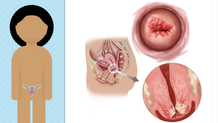 Kesehatan Rahim Itu Aset! Girls, Ketahui 5 Fakta Vaksin HPV Ini Demi Masa Depanmu