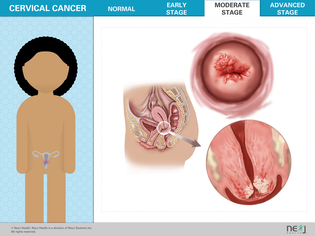 Kesehatan Rahim Itu Aset! Girls, Ketahui 5 Fakta Vaksin HPV Ini Demi Masa Depanmu