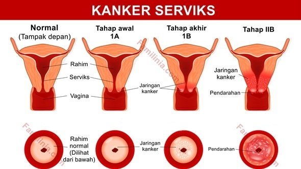 Kesehatan Rahim Itu Aset! Girls, Ketahui 5 Fakta Vaksin HPV Ini Demi Masa Depanmu