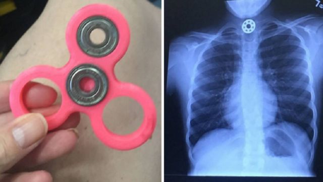 Nggak Cuma Smartphone, Kini Ada Juga Kasus Fidget Spinner yang Meledak! Wah Bahaya Nih