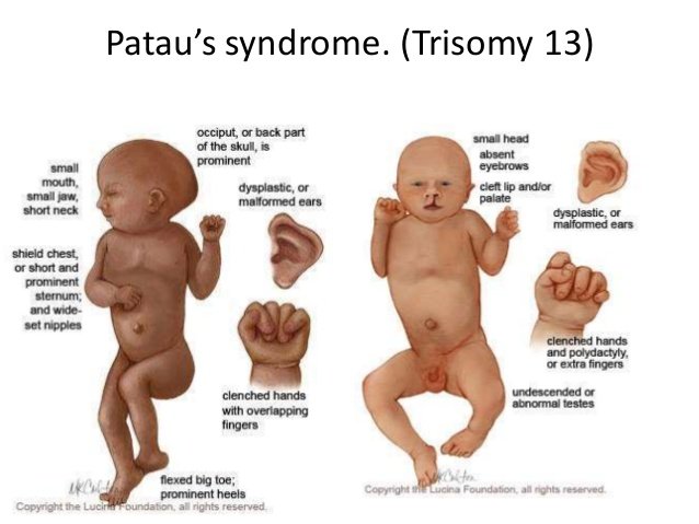 Kisah Bayi Mungil Adam Begitu Mengharukan. Ini Fakta yang Mesti Kamu Tahu Soal Penyakitnya