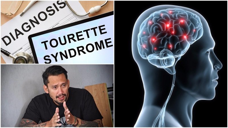 4 Fakta Tentang Tourette, Sindrom yang Sebabkan Tora Sudiro Sampai Terciduk Karena Konsumsi Dumolid