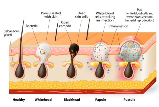 Tahapan munculnya jerawat
