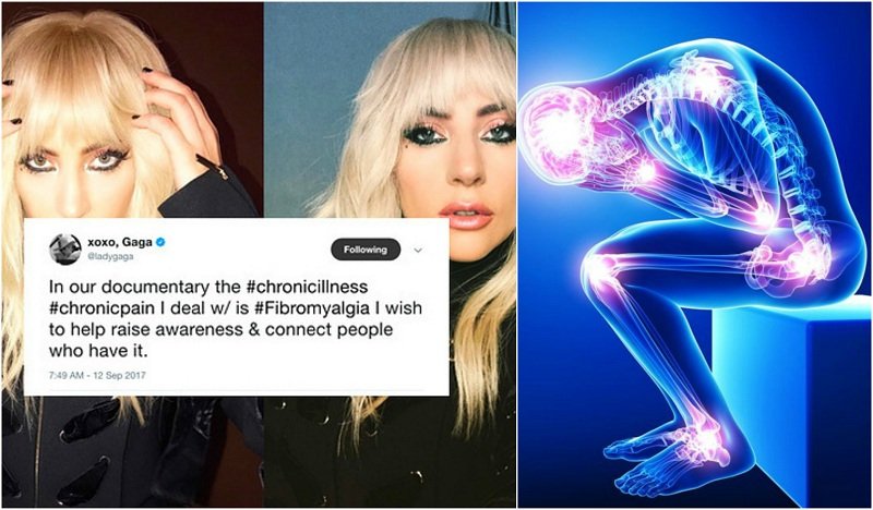 Lady Gaga Mengaku Mengidap Fibromyalgia, Nggak Main-main Penyakit Ini Sungguh Menyiksa Lho