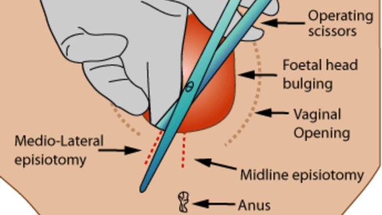 Fakta Tentang Sayatan Episiotomi di Kulit Miss V Saat Melahirkan Normal