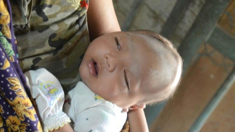 Diduga Karena Sering Dipijat, Bayi Ini Alami Pendarahan Otak