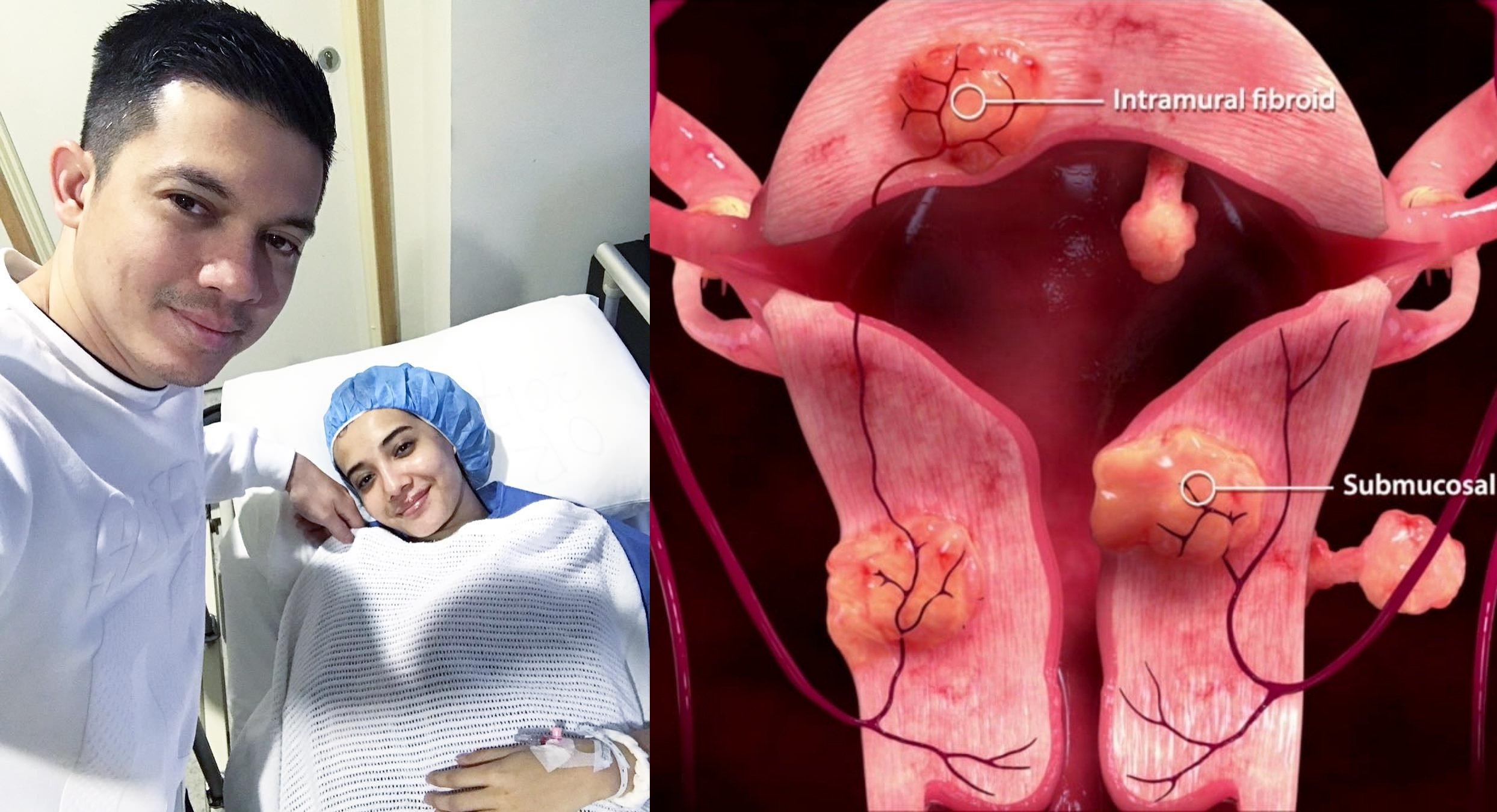 Waspada Endometriosis dan Fibroid Seperti yang Dialami Oleh Zaskia Sungkar. Ini Penjelasannya!