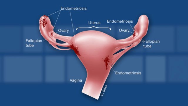 Waspada Endometriosis dan Fibroid Seperti yang Dialami Oleh Zaskia Sungkar. Ini Penjelasannya!