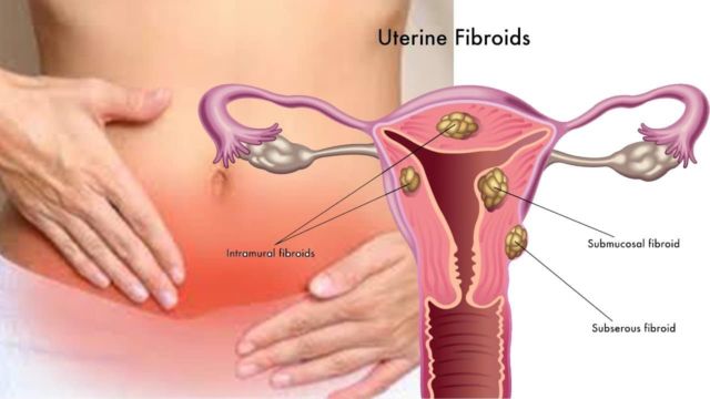 Waspada Endometriosis dan Fibroid Seperti yang Dialami Oleh Zaskia Sungkar. Ini Penjelasannya!