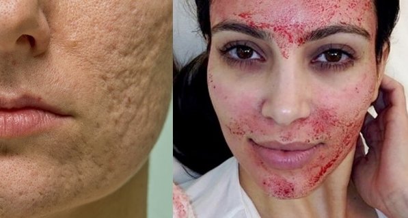 Menghilangkan Bopeng dan Bekas Jerawat Kini Bukan Lagi Mimpi. Vampire Facial Salah Satu Solusinya!