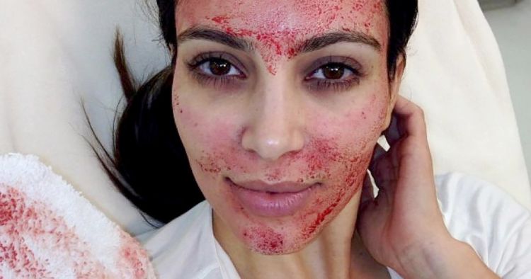 Menghilangkan Bopeng dan Bekas Jerawat Kini Bukan Lagi Mimpi. Vampire Facial Salah Satu Solusinya!