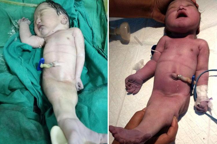 Bayi di India Lahir dengan Kaki Menyatu Mirip Putri Duyung. Ternyata Sindrom Ini Penyebabnya