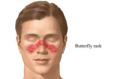 Butterfly Rash