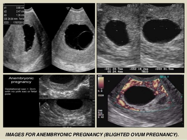 6 Fakta Hamil Kosong atau Blighted Ovum. Gejalanya Hamil, tapi Janin Tak Berkembang Sempurna