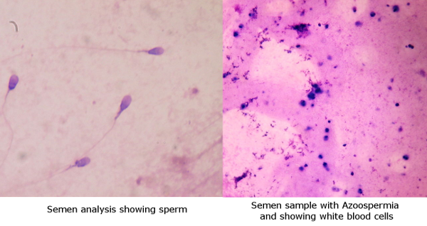 Azoospermia, Kelainan Pada Sperma Cowok yang Bikin Sulit Menghamili. Waspada Meski Nggak Mengalami