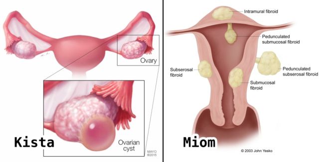 perbedaan kista dan miom
