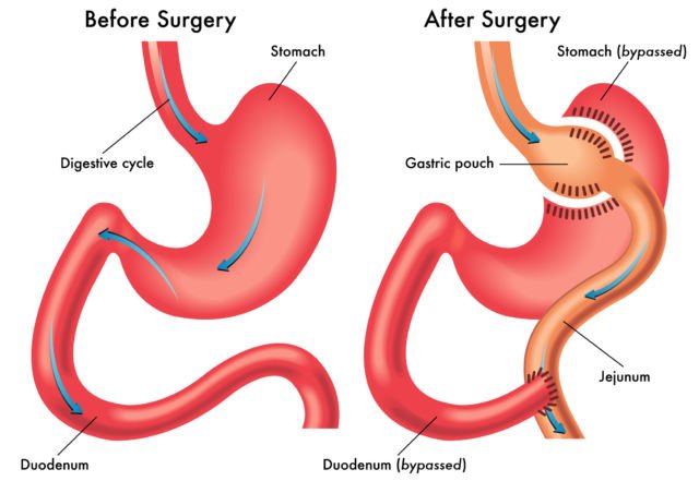 Bobot 299 Kilo Amber Rachdi Susut Drastis Berkat Operasi Gastric Bypass. Kayak Apa Sih Prosedurnya?