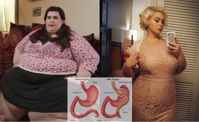 Bobot 299 Kilo Amber Rachdi Susut Drastis Berkat Operasi Gastric Bypass. Kayak Apa Sih Prosedurnya?