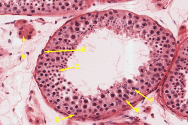 Azoospermia, Kelainan Pada Sperma Cowok yang Bikin Sulit Menghamili. Waspada Meski Nggak Mengalami