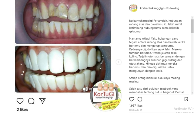 Veneer jangan sembarangan!