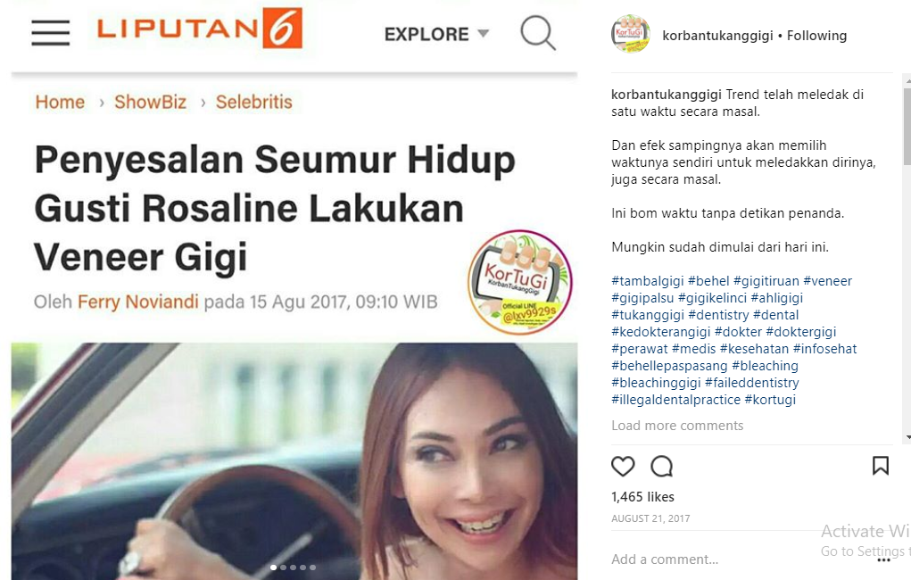 Fakta Soal Veneer Gigi yang Dikupas Habis Akun @korbantukanggigi; Mau Trendi Tapi Malah Rugi