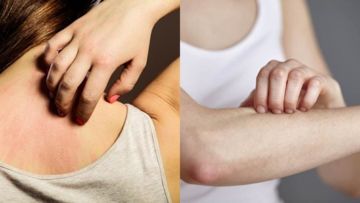 9 Tips Berguna Untuk Kulit Kering Sensitif dan Dermatitis Atopik. Biar Nggak Makin Gatal dan Busik!