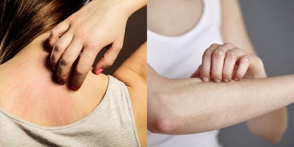 9 Tips Berguna Untuk Kulit Kering Sensitif dan Dermatitis Atopik. Biar Nggak Makin Gatal dan Busik!