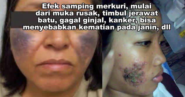 Nggak Boleh Sembarangan! Inilah Alasan Kenapa Obat Jerawat Pilihanmu Harus Punya Izin BPOM