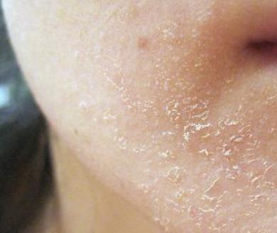 Dry Skin Patches on Face,